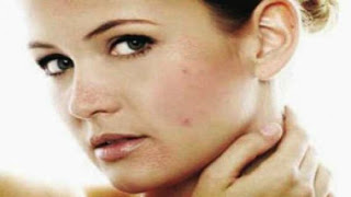 remedies for black spots on face, Hometips
