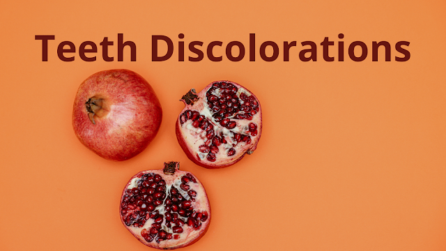 Teeth Discolorations