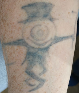 Tattoo fading after third picosure session