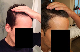 before after fue hair transplant 9 months