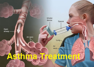 Testosterone Content Explains Severe Asthma Inward Women