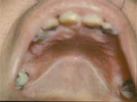 <Img src="estomatitis-subprótesis-grado-2.jpg" width = "220" height "164" border = "0" alt = "Inflamación mucosa del paladar por prótesis dental">