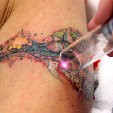 tattoo removal