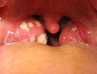 Tonsil Removal Recovery Time Adults : All About The Symptoms Of Tonsillitis