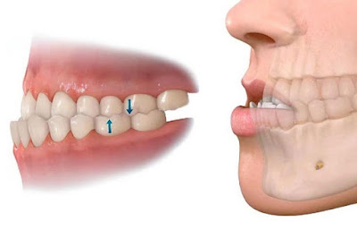 Bọc răng sứ khi bị móm hiệu quả khi nào?