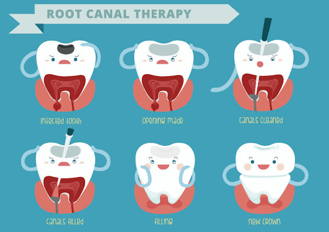 http://cosmodentists.com/general-dentistry-root-canal-treatment.html