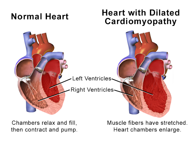 Ilustrasi gambaran kardiomiopati dilatasi dilated cardiomiopathy illustration jantung heart