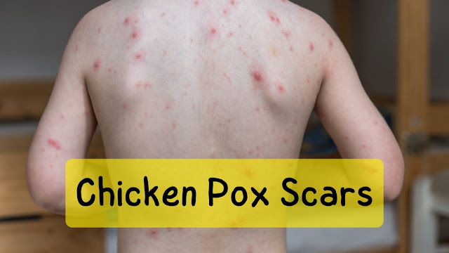 old chicken pox scars removal