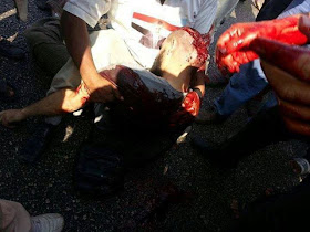  [ Gambar ] Rakyat Mesir Penyokong Dr Morsi Yang Ditembak Oleh Tentera Sekular Mesir  Dikepala | [ MESIR HARI INI ] IN SYA ALLAH SYURGA UNTUK BELIAU | 