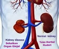 Sakit Pada Organ Ginjal