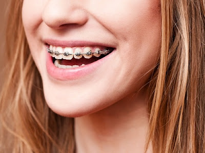 Niềng răng mắc cài kim loại có hiệu quả không?