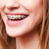 Niềng răng mắc cài kim loại có tốt không? 