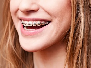 Niềng răng mắc cài kim loại có tốt không? 