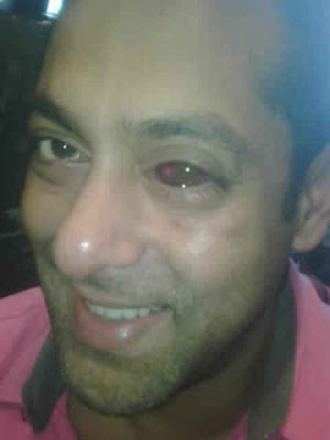 Salman Khan red eye