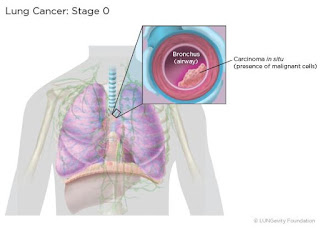 lung cancer stage