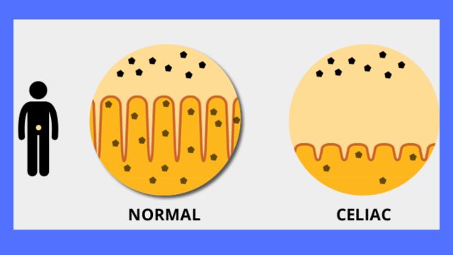 Key points about celiac disease