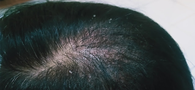 ketombe pada rambut