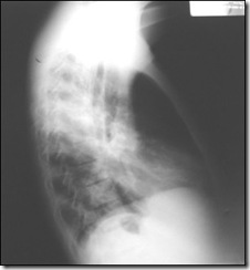 radiografia de tórax  perfil mostram imagem de consolidação localizada em lobo superior direito