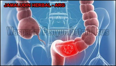 http://tilupuluhherbal.blogspot.com/2018/07/cara-alami-menyembuhkan-penyumbatan-usus.html