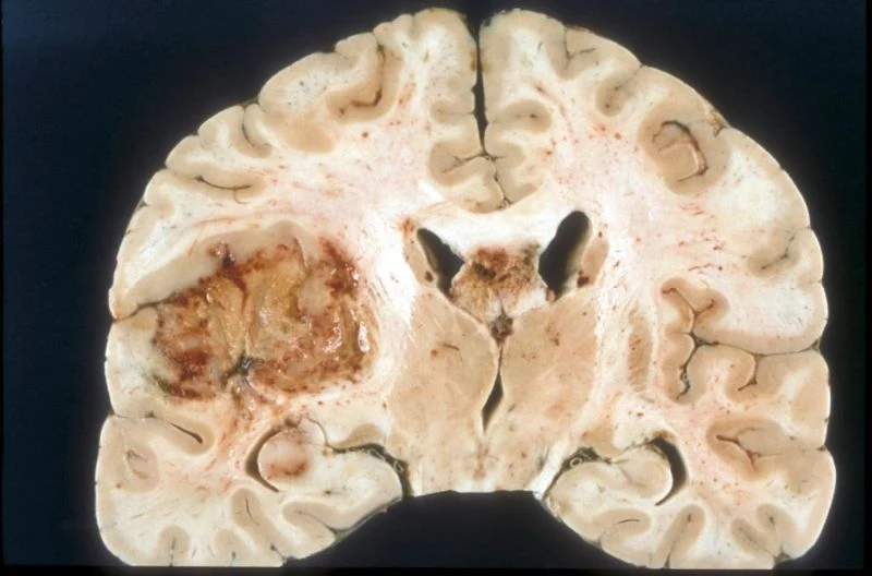 Se reduce el crecimiento del tumor mediante el uso de terapia genética CRISPR