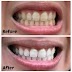 How to whitening Teeth with 5 Home Remedy Treatment