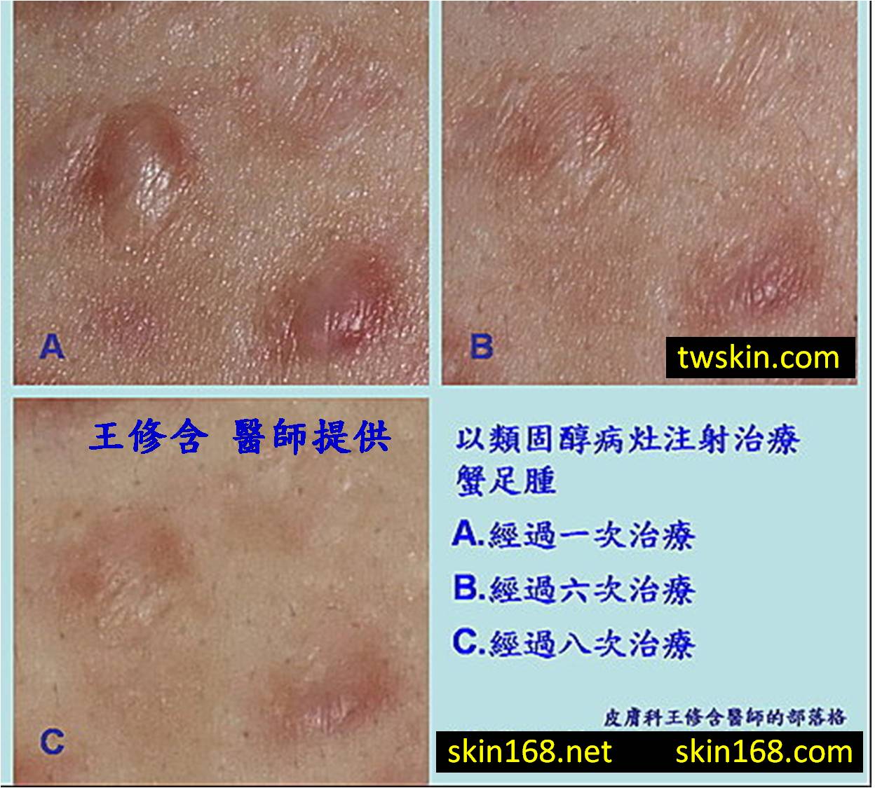 皮膚科王修含醫師 蟹足腫 肥厚性疤痕治療 類固醇病灶注射之效果