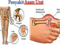 Pantangan Asam Urat Nanas