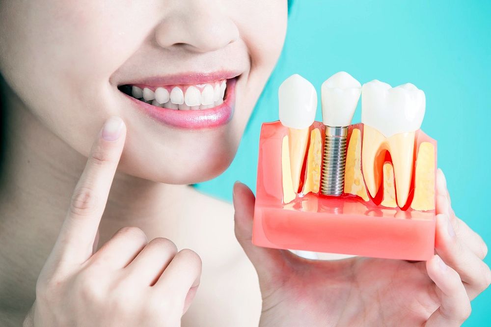 Dental Implants