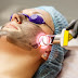 Carbon Dioxide Laser Skin Resurfacing Dubai & Abu Dhabi - Remove Wrinkles, Scars, Warts and Rejuvenate Skin