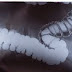 Los síntomas del cáncer de colon