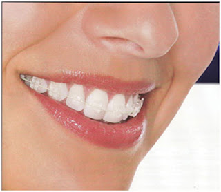 Quy trình niềng răng mắc cài sứ chuẩn-1