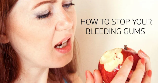 Bleeding Gums