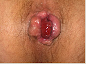 ATASI AMBEIEN WASIR