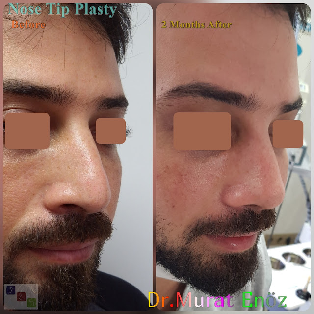 Before and 2 Months After Nose Tip Plasty in Men