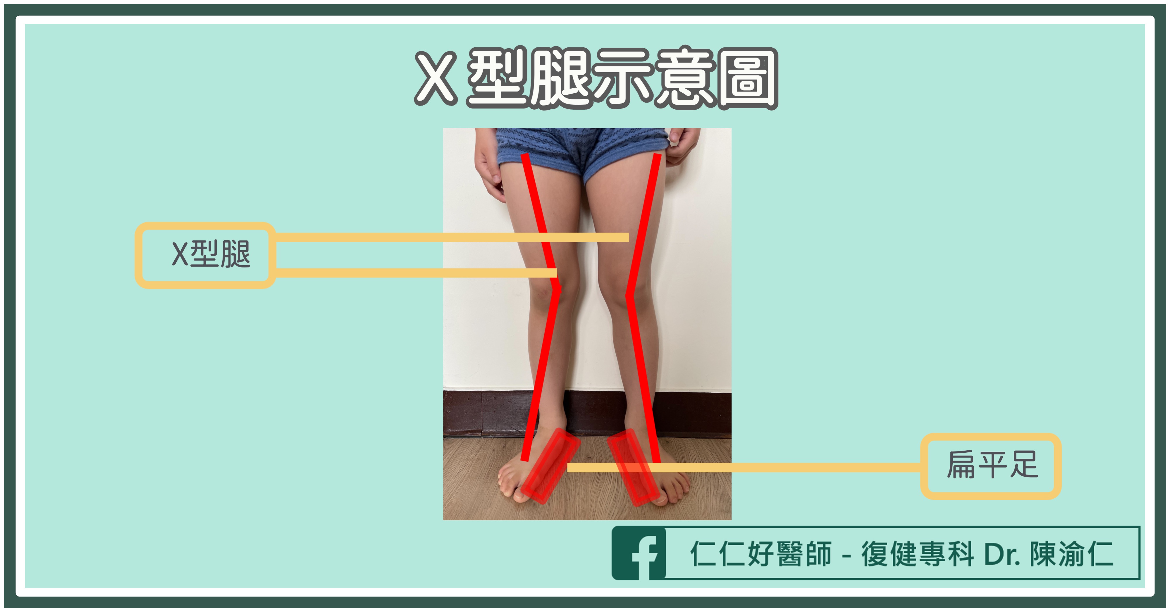 【腿型矯正】XO型腿—張力失衡 — 樞適物理治療 Central X Physical Therapy