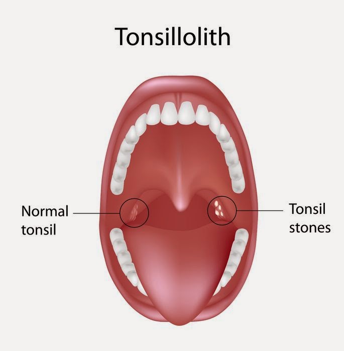 symptoms of tonsil stones