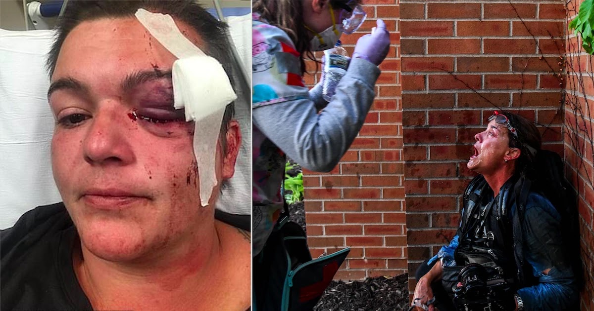 Journalist Permanently Blinded In One Eye After Being Shot With Rubber Bullet, Journalists Across The US Report Being Attacked From Police