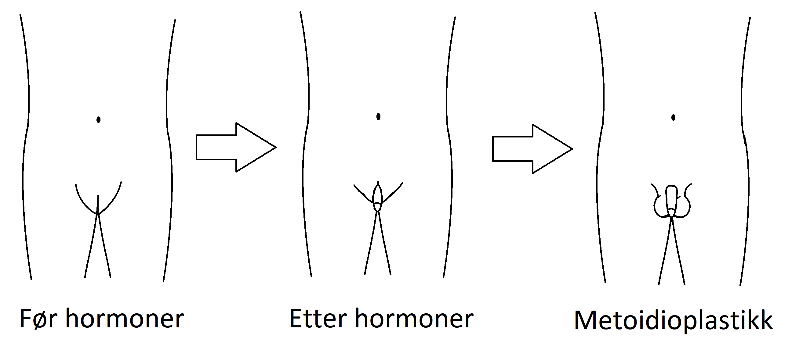 Illustration of metoidioplasty