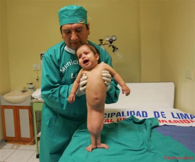 Girl Born With Two Legs