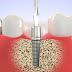  Trồng răng implant giá bao nhiêu tiền?