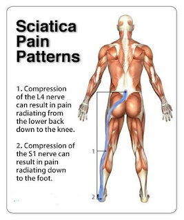 sciatica treatments