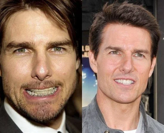 Tom Cruise's dental surgery