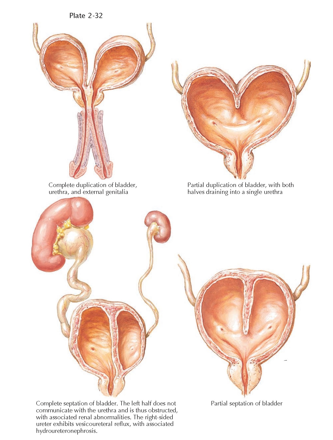 BLADDER DUPLICATION AND SEPTATION