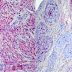 Neurofibroma vs Schwannoma pathology