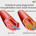 TANDA-TANDA ANDA MENGALAMI KOLESTROL YANG TINGGI