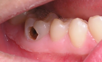 Răng sâu nhổ nguy hiểm không?