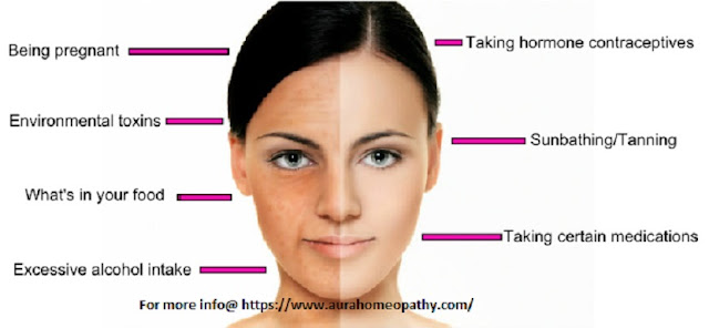 Treating Facial Pigmentation