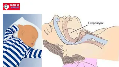 What is Obstructive sleep apnea (OSA)?