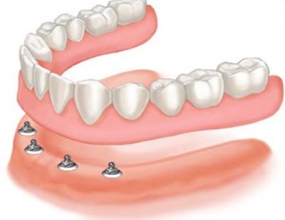 Hàm giả tháo lắp có chi phí hợp lý