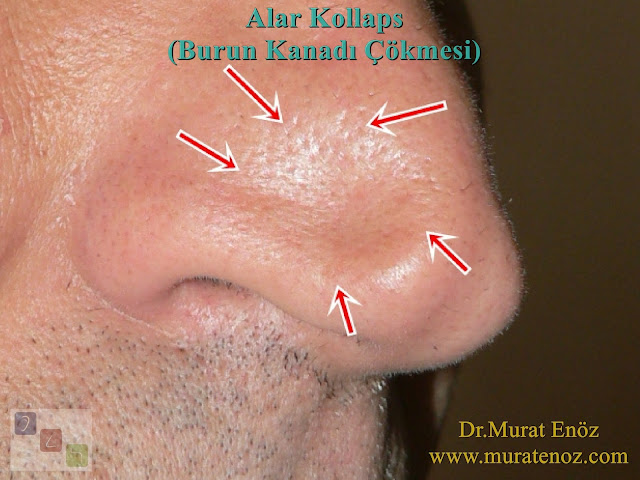 Burun kanadında çökme neden olur? - Burun kanadı çökmesi nasıl tedavi edilir? - Alar kollaps nedir? - Burun kanadı estetiği - Burun kanadı çökmesi ameliyatı - Alar kollaps tedavisi - Nazal valv cerrahisi - İç nazal valv - Dış nazal valv